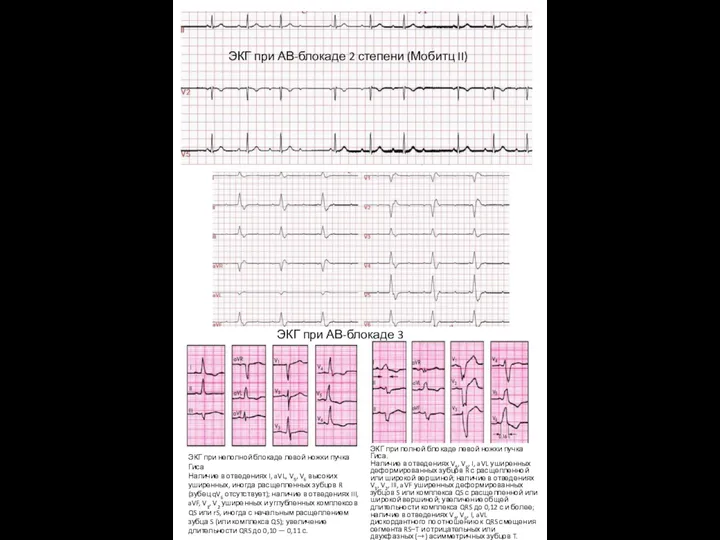 ЭКГ при АВ-блокаде 2 степени (Мобитц II) ЭКГ при АВ-блокаде 3 степени ЭКГ