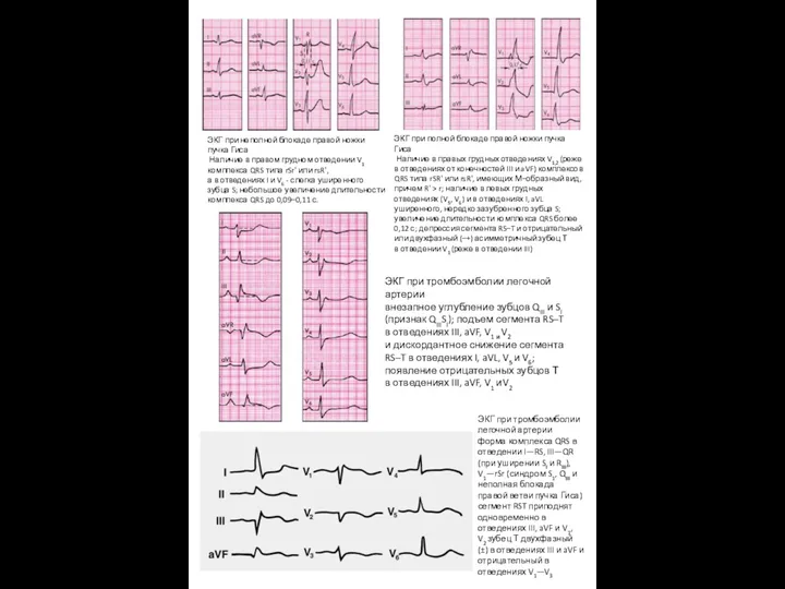 ЭКГ при неполной блокаде правой ножки пучка Гиса Наличие в правом грудном отведении