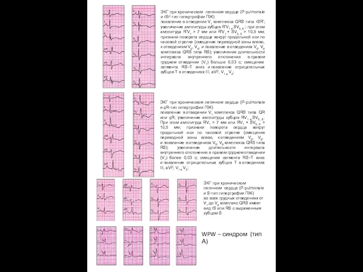 ЭКГ при хроническом легочном сердце (Р-pulmonale и rSr'-тип гипертрофии ПЖ) появление в отведении