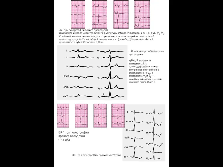 ЭКГ при гипертрофии левого предсердия раздвоение и небольшое увеличение амплитуды зубцов Р в