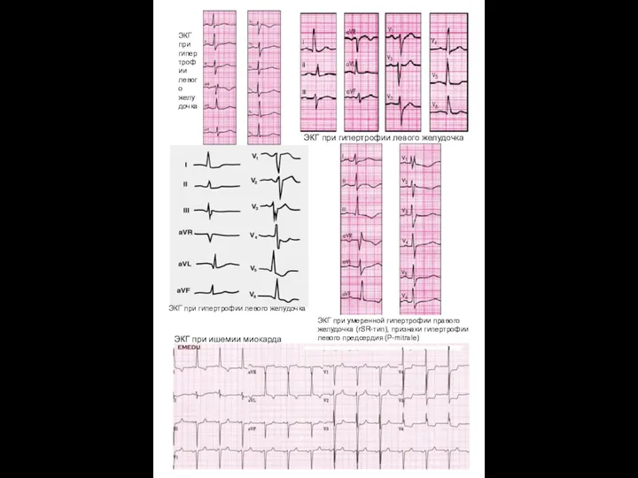 ЭКГ при гипертрофии левого желудочка ЭКГ при гипертрофии левого желудочка ЭКГ при гипертрофии