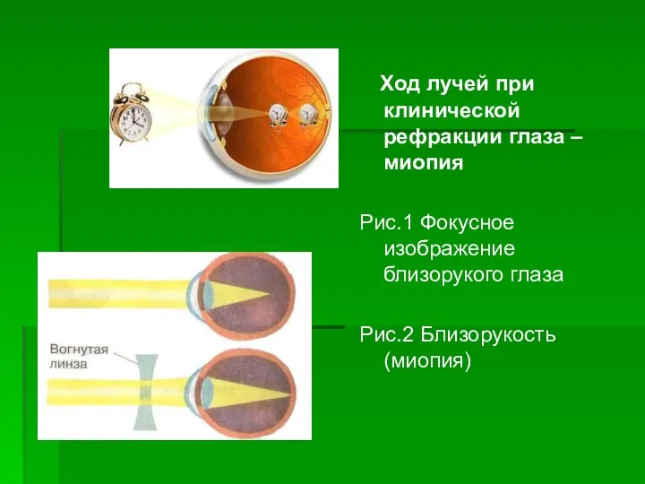 Ход лучей при клинической рефракции глаза – миопия Рис.1 Фокусное изображение близорукого глаза Рис.2 Близорукость (миопия)