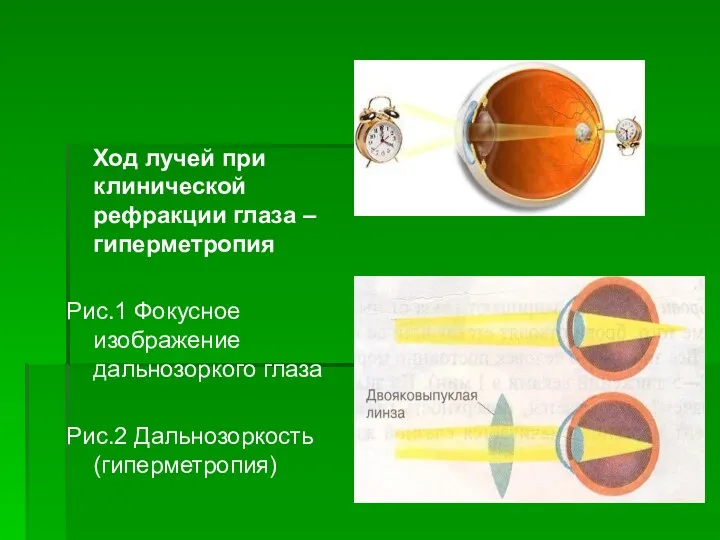 Ход лучей при клинической рефракции глаза – гиперметропия Рис.1 Фокусное изображение дальнозоркого глаза Рис.2 Дальнозоркость (гиперметропия)