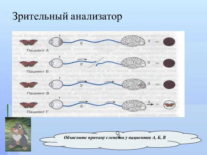 Зрительный анализатор Объясните причину слепоты у пациентов А, Б, В
