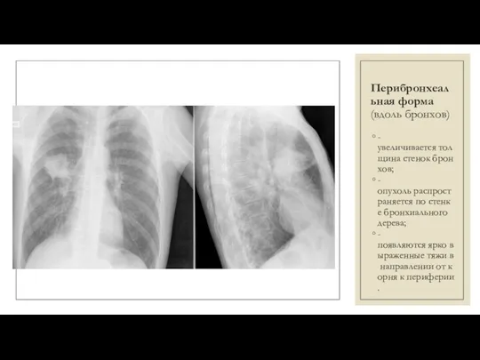 Перибронхеальная форма (вдоль бронхов) -увеличивается толщина стенок бронхов; -опухоль распространяется