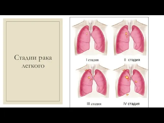 Стадии рака легкого