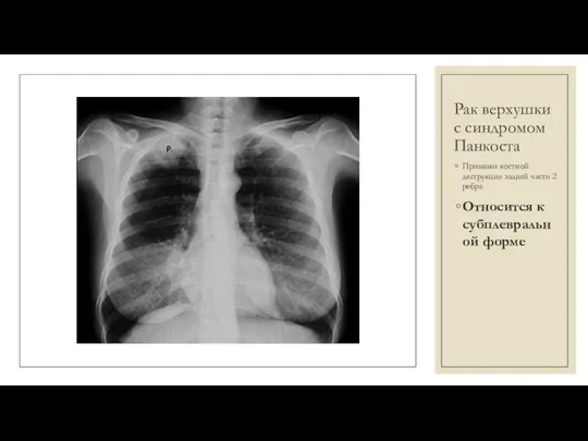 Рак верхушки с синдромом Панкоста Признаки костной деструкции задней части 2 ребра Относится к субплевральной форме