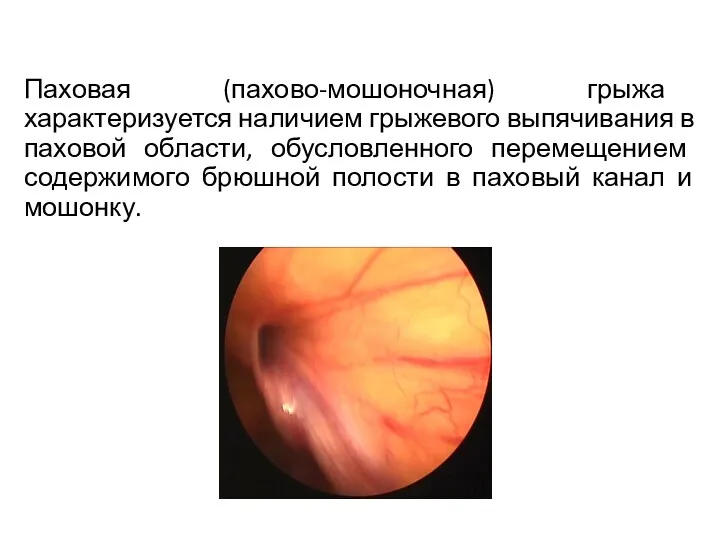 Паховая (пахово-мошоночная) грыжа характеризуется наличием грыжевого выпячивания в паховой области,