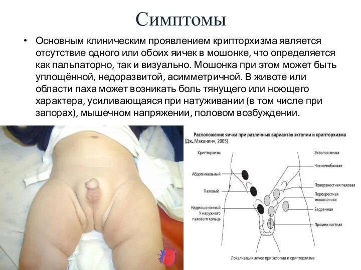 Симптомы Основным клиническим проявлением крипторхизма является отсутствие одного или обоих