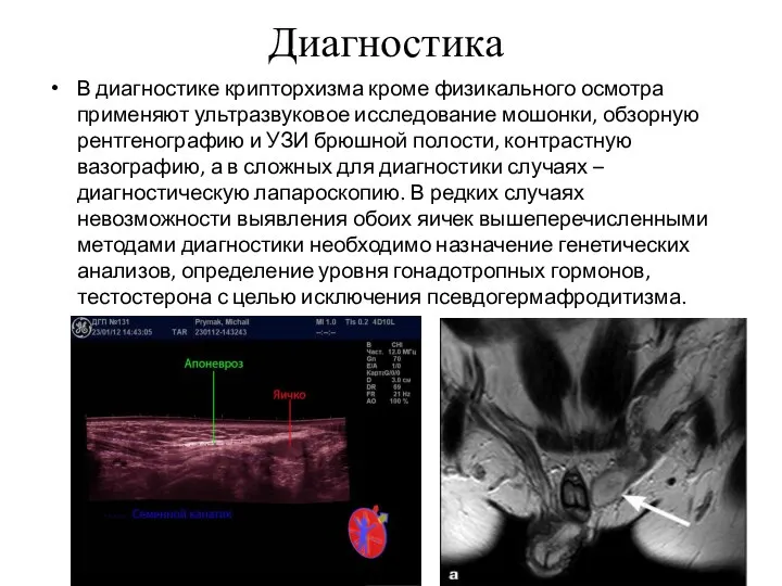 Диагностика В диагностике крипторхизма кроме физикального осмотра применяют ультразвуковое исследование