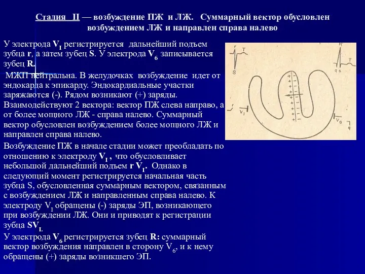 Стадия II — возбуждение ПЖ и ЛЖ. Суммарный вектор обусловлен возбуждением ЛЖ и