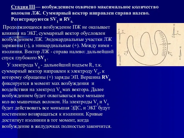 Стадия III— возбуждением охвачено максимальное количество волокон ЛЖ. Суммарный вектор