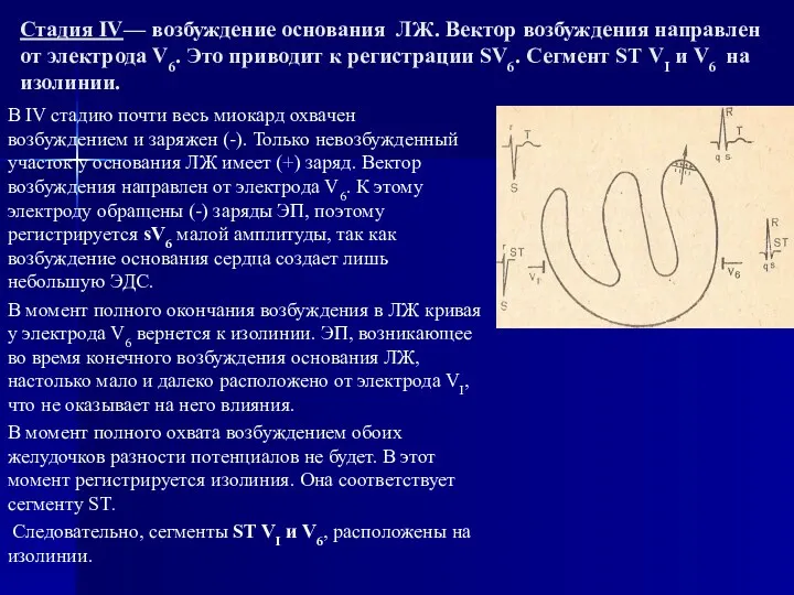 Стадия IV— возбуждение основания ЛЖ. Вектор возбуждения направлен от электрода V6. Это приводит