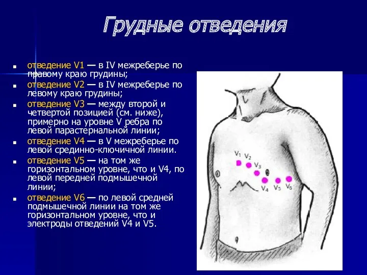 Грудные отведения отведение V1 — в IV межреберье по правому краю грудины; отведение