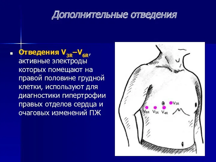 Дополнительные отведения Отведения V3R–V6R, активные электроды которых помещают на правой половине грудной клетки,