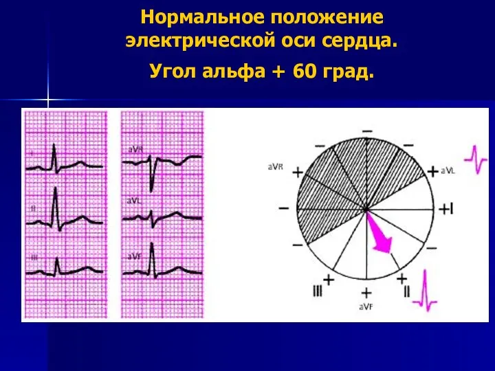 Нормальное положение электрической оси сердца. Угол альфа + 60 град.