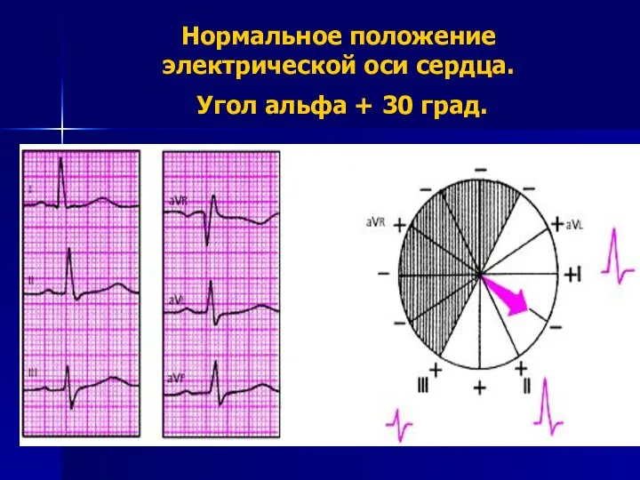 Нормальное положение электрической оси сердца. Угол альфа + 30 град.