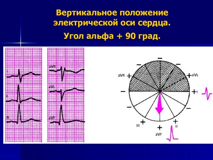 Вертикальное положение электрической оси сердца. Угол альфа + 90 град.