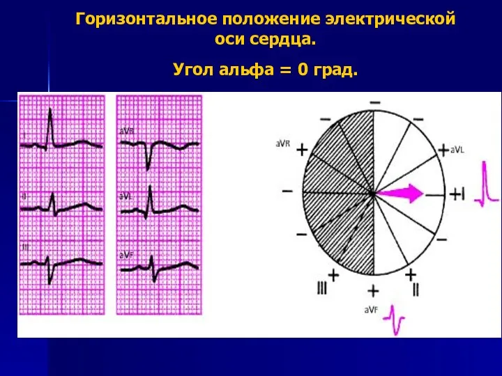 Горизонтальное положение электрической оси сердца. Угол альфа = 0 град.