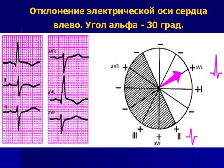 Отклонение электрической оси сердца влево. Угол альфа - 30 град.