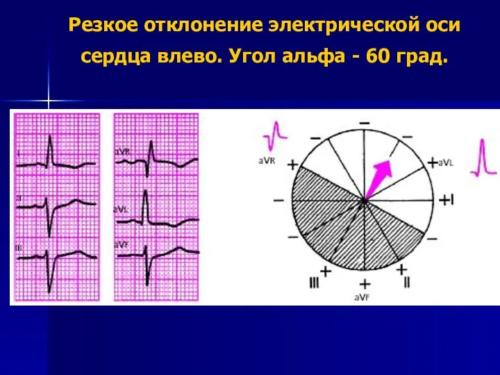 Резкое отклонение электрической оси сердца влево. Угол альфа - 60 град.