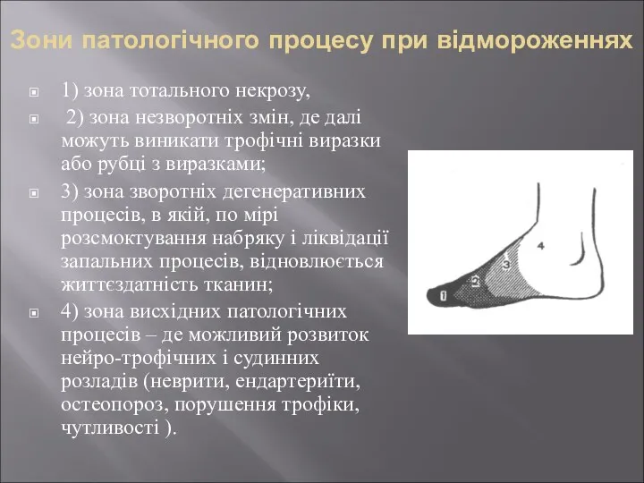 Зони патологічного процесу при відмороженнях 1) зона тотального некрозу, 2)