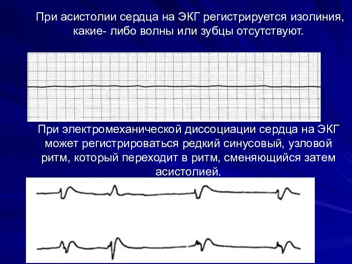 При асистолии сердца на ЭКГ регистрируется изолиния, какие- либо волны