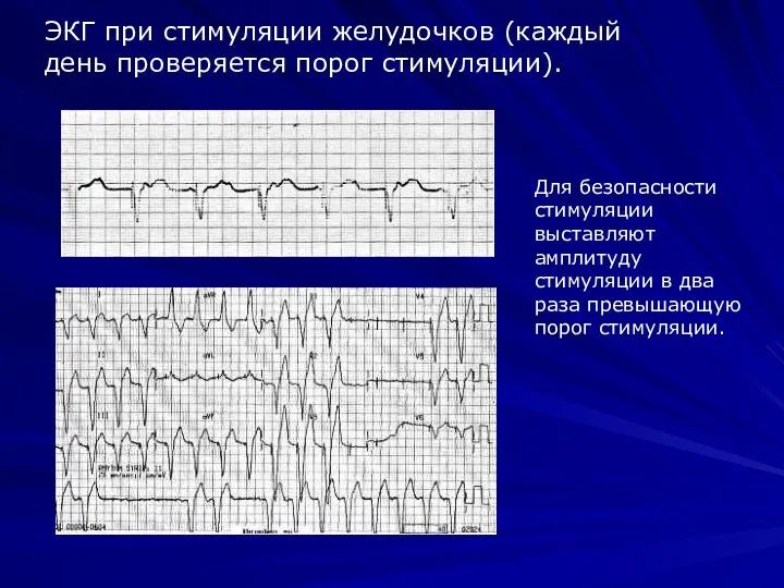 ЭКГ при стимуляции желудочков (каждый день проверяется порог стимуляции). Для