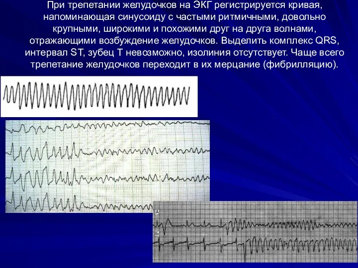 При трепетании желудочков на ЭКГ регистрируется кривая, напоминающая синусоиду с