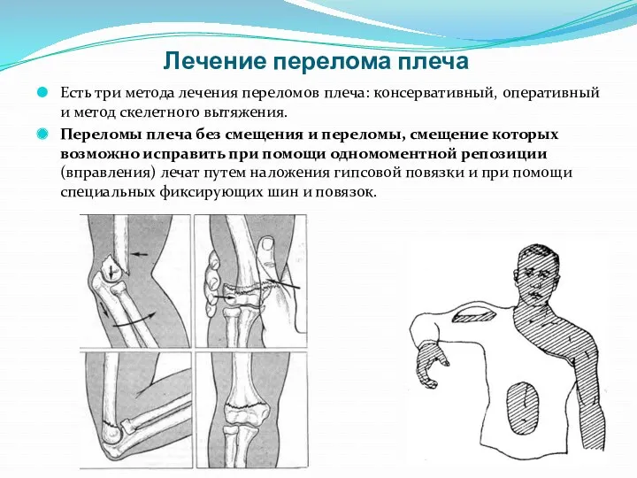 Лечение перелома плеча Есть три метода лечения переломов плеча: консервативный, оперативный и метод