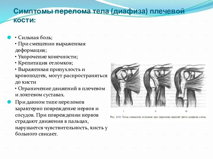 Симптомы перелома тела (диафиза) плечевой кости: • Сильная боль; • При смещении выраженная