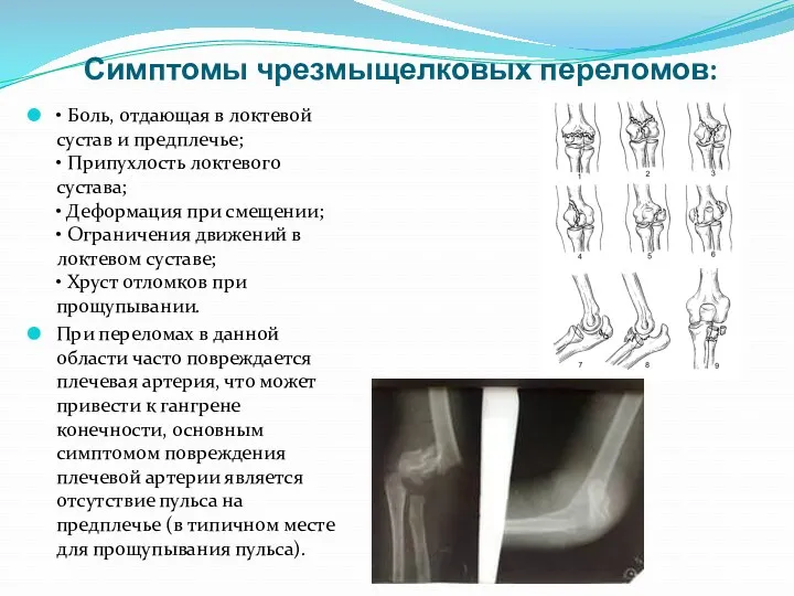 Симптомы чрезмыщелковых переломов: • Боль, отдающая в локтевой сустав и