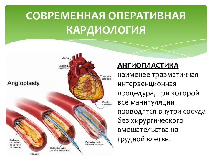 СОВРЕМЕННАЯ ОПЕРАТИВНАЯ КАРДИОЛОГИЯ АНГИОПЛАСТИКА – наименее травматичная интервенционная процедура, при которой все манипуляции