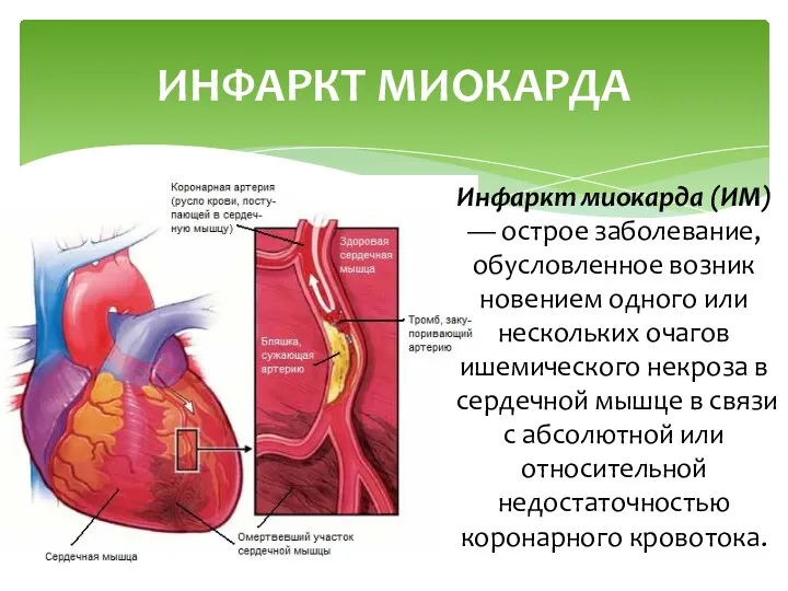 Инфаркт миокарда (ИМ) — острое заболевание, обусловленное возник­новением одного или нескольких очагов ишемического