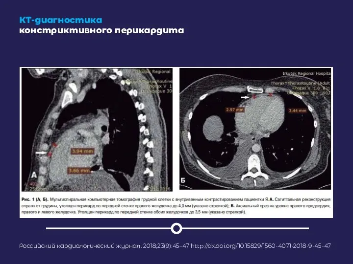 КТ-диагностика констриктивного перикардита Российский кардиологический журнал. 2018;23(9):45–47 http://dx.doi.org/10.15829/1560-4071-2018-9-45-47