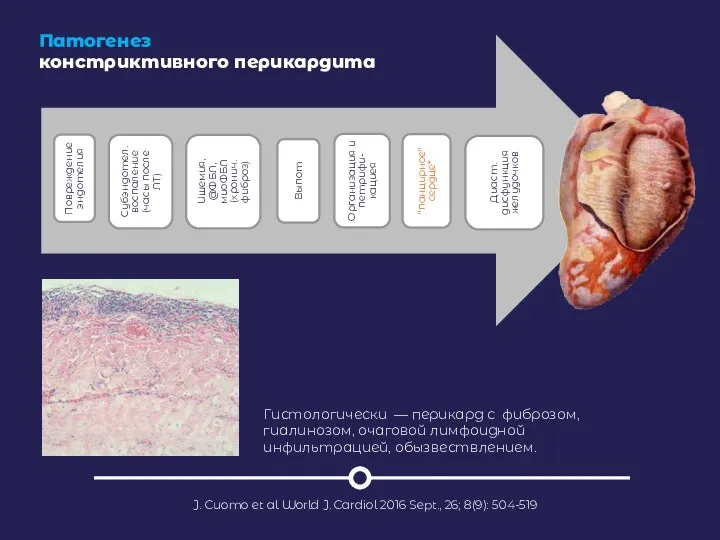 Патогенез констриктивного перикардита J. Cuomo et al World J. Cardiol