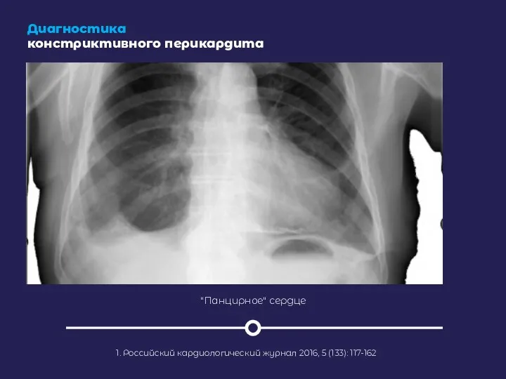 Диагностика констриктивного перикардита 1. Российский кардиологический журнал 2016, 5 (133): 117-162 "Панцирное" сердце