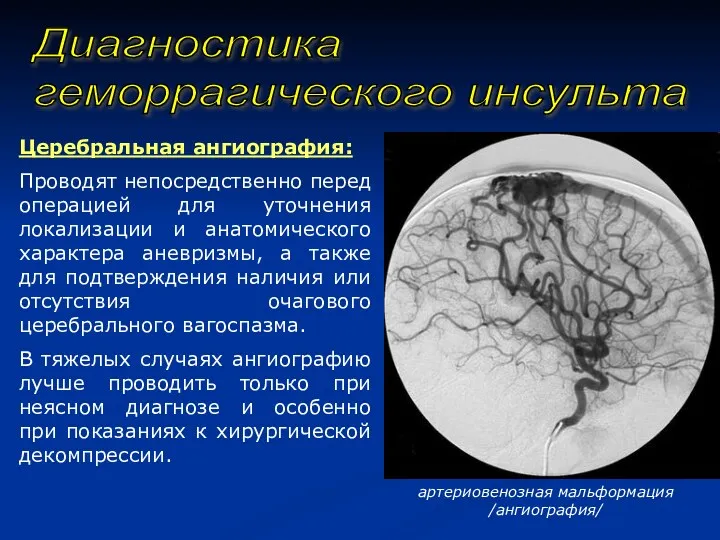 Диагностика геморрагического инсульта Церебральная ангиография: Проводят непосредственно перед операцией для уточнения локализации и
