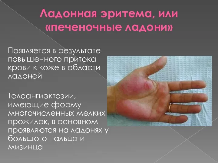 Ладонная эритема, или «печеночные ладони» Появляется в результате повышенного притока крови к коже