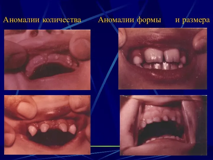 Аномалии количества Аномалии формы и размера