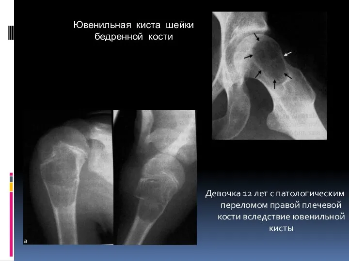 Ювенильная киста шейки бедренной кости Девочка 12 лет с патологическим