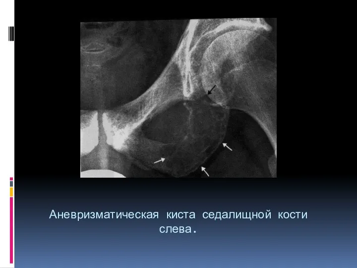 Аневризматическая киста седалищной кости слева.