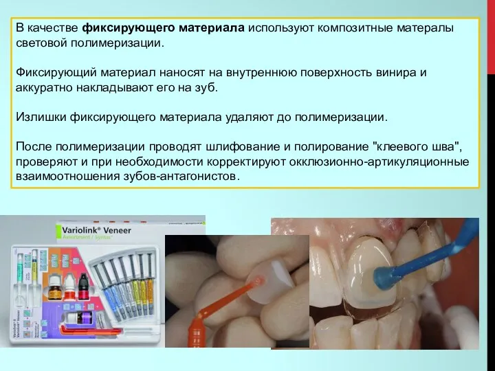 В качестве фиксирующего материала используют композитные матералы световой полимеризации. Фиксирующий