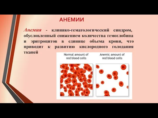 АНЕМИИ Анемия - клинико-гематологический синдром, обусловленный снижением количества гемоглобина и эритроцитов в единице