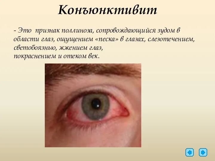 Конъюнктивит - Это признак поллиноза, сопровождающийся зудом в области глаз, ощущением «песка» в