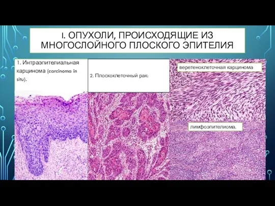 I. ОПУХОЛИ, ПРОИСХОДЯЩИЕ ИЗ МНОГОСЛОЙНОГО ПЛОСКОГО ЭПИТЕЛИЯ 1. Интраэпителиальная карцинома