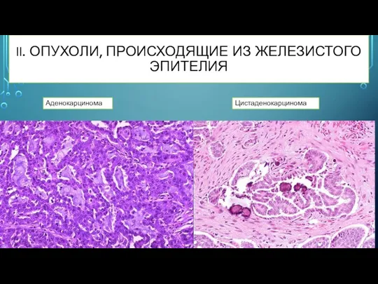 II. ОПУХОЛИ, ПРОИСХОДЯЩИЕ ИЗ ЖЕЛЕЗИСТОГО ЭПИТЕЛИЯ Аденокарцинома Цистаденокарцинома