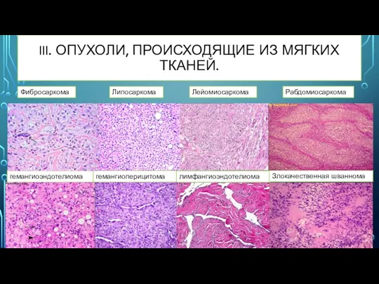 III. ОПУХОЛИ, ПРОИСХОДЯЩИЕ ИЗ МЯГКИХ ТКАНЕЙ. Фибросаркома Липосаркома Лейомиосаркома Рабдомиосаркома гемангиоэндотелиома гемангиоперицитома лимфангиоэндотелиома Злокачественная шваннома