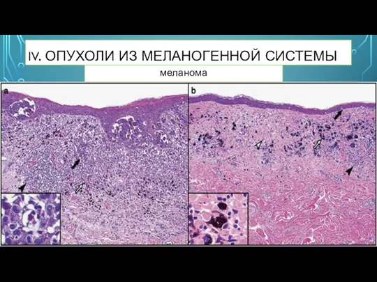 IV. ОПУХОЛИ ИЗ МЕЛАНОГЕННОЙ СИСТЕМЫ меланома