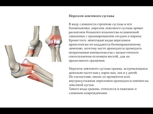 Перелом локтевого сустава В виду сложности строения сустава и его биомеханики, перелом локтевого